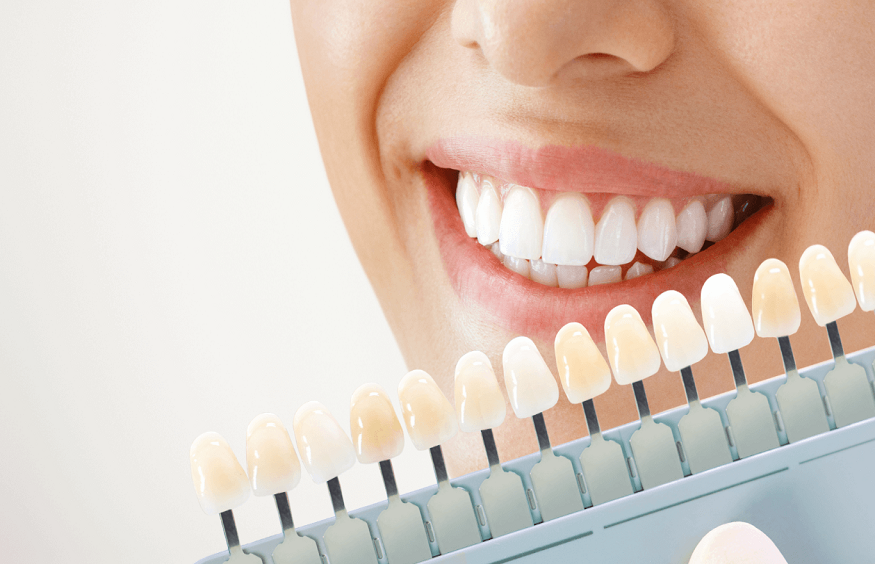 Safe And Effective Teeth Whitening